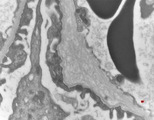 F,14y. | Alport syndrome - split and laminated, thick/thin basement membranes